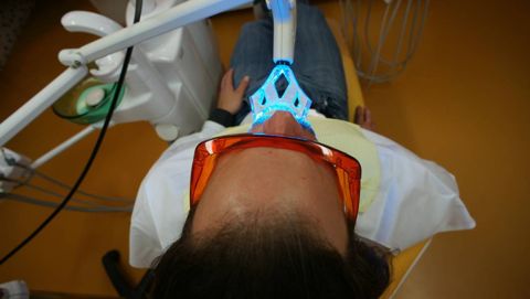 Bleichung in der Zahnarztpraxis mit Hilfe der Plasmalampe Rembrand Sapphire