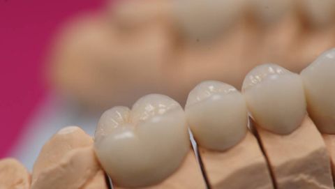 Vollkeramische Kronen auf dem Arbeitsmodell