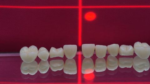 Vollkeramische Kronen aus der Keramik Turcom Cera
