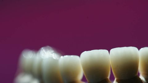 Transparenz der vollkeramischen Kronen
