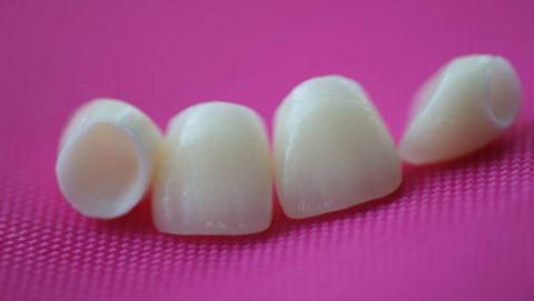 Vollkeramische Kronen aus der Keramik Turcom Cera