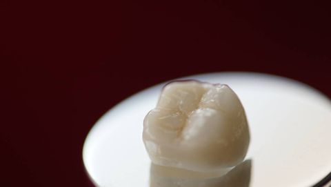 Vollkeramische Kronen aus der Keramik Turcom Cera