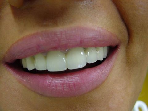 Metallkeramische Kronen im Mund