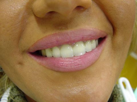 Metallkeramische Kronen im Mund