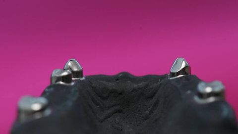Primäre Teleskopkronen (Remanium Star)