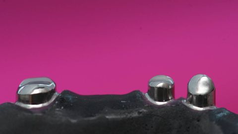 Primäre Teleskopkronen (Remanium Star)