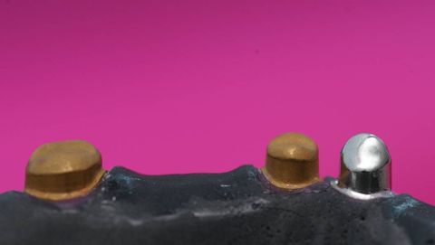 Sekundäre Galvanoteleskope - Galvanotechnologie Solaris Degudent