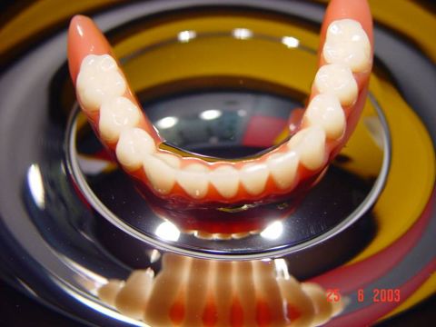 Teleskopprothese